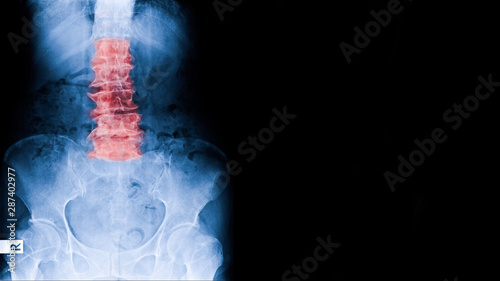 X-ray image elderly people have low back pain X-ray show lumbar spine spondylosis means degenerative changes of spine in old age. photo
