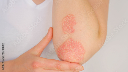 CLOSE UP Woman with big red scaly rash suffering from elbow psoriatic arthritis photo