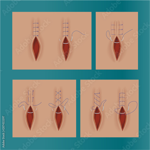 Surgical stitches