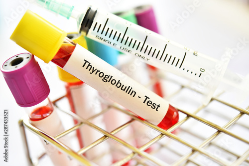 Blood sample tube for thyroglobulin test photo