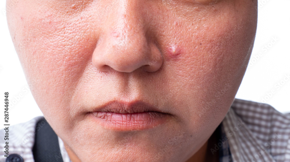 Obraz premium Zbliżenie czerwona skóra z acnes