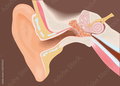 Section of the ear with cholesteatoma photo