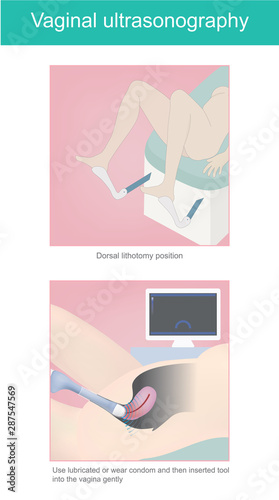 Vaginal ultrasonography. 3D Illustration anatomy human body.