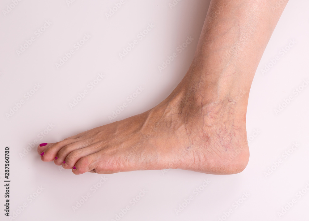 Varicose veins on the female foot. Varicose veins closeup. Leg of a girl with varicose veins on a light background. Varicose veins on the female foot. Varicose veins closeup. Leg of a girl with varicose veins on a light background.
