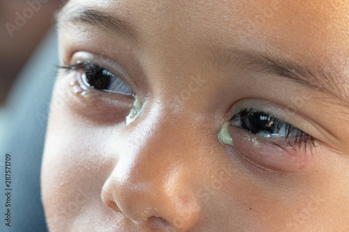 A young toddler looks uncomfortable and in pain with a severe viral conjunctivitis infection. With pus discharge and swollen lower eyelids, red and puffy. photo