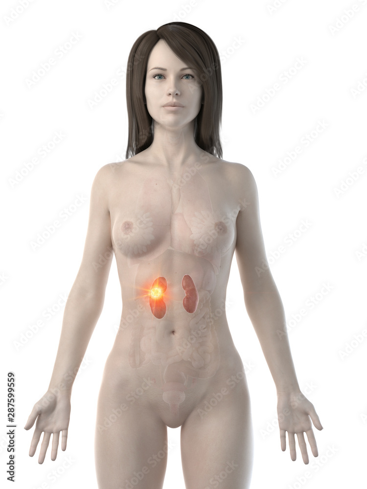 Fototapeta premium 3d rendered medically accurate illustration of a womans kidneys cancer
