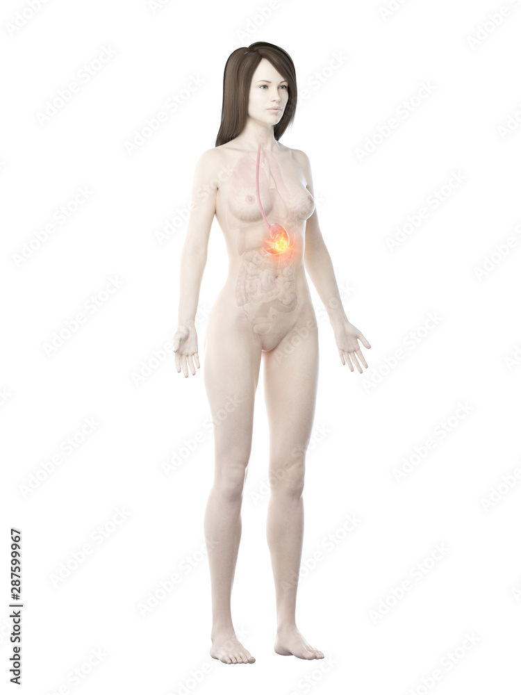 Naklejka premium 3d rendered medically accurate illustration of a womans stomach cancer
