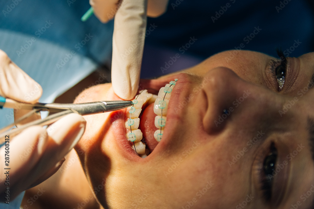 process of placing white dental braces to a Caucasian girl in a dental clinic with a dentist girl