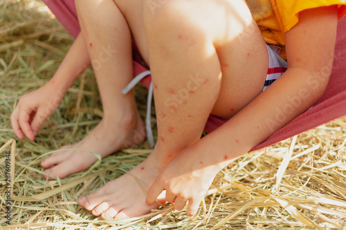 Mosquito bites sore and scar on little child legs and hands who sitting on the grass