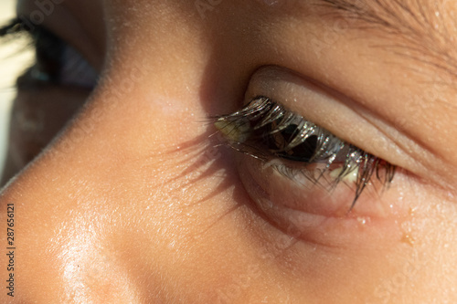 A closeup view on the eye of a young boy with an extreme case of conjunctivitis, with visible yellow and crusty discharge around the edges and eyelashes.