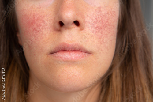 A closeup view on the lower face area of a thirty year old caucasian girl, suffering from red blotchy cheeks and dilated blood vessels, symptomatic of rosacea.