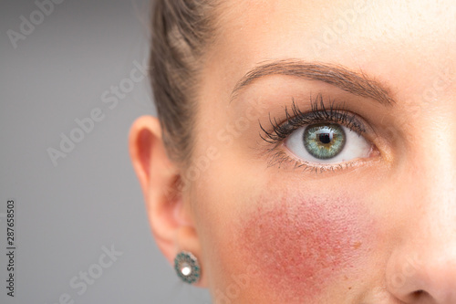 Red flushing cheeks are seen closeup, in the face of a stunning thirty something caucasian girl, permanent redness and small visible blood vessels, symptoms of rosacea with room for copy.