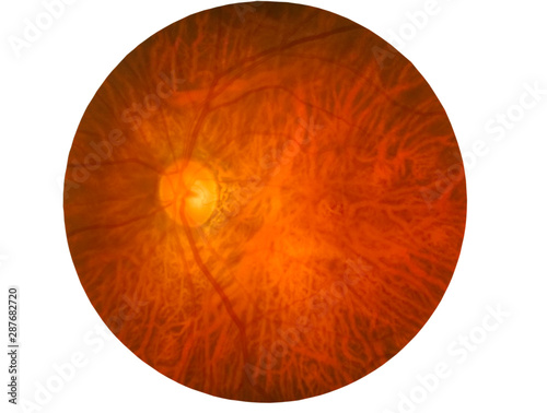 Retina of diabetes , diabates retinopathy,photo Medical Retina Abnormal isolated on white background.Saved with clipping path