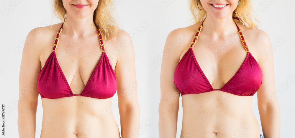 Woman posing in bikini top before and after breast augmentation plastic  surgery with silicone breast implants Stock Photo | Adobe Stock