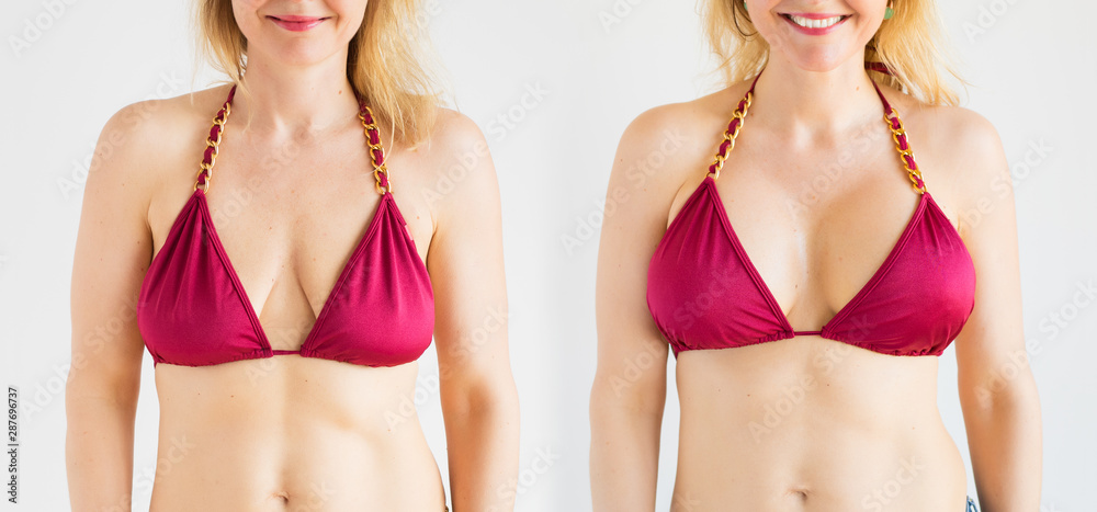 Woman Posing In Bikini Top Before And After Breast Augmentation Plastic 