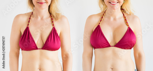 Fotografie, Obraz Woman posing in bikini top before and after breast augmentation plastic surgery