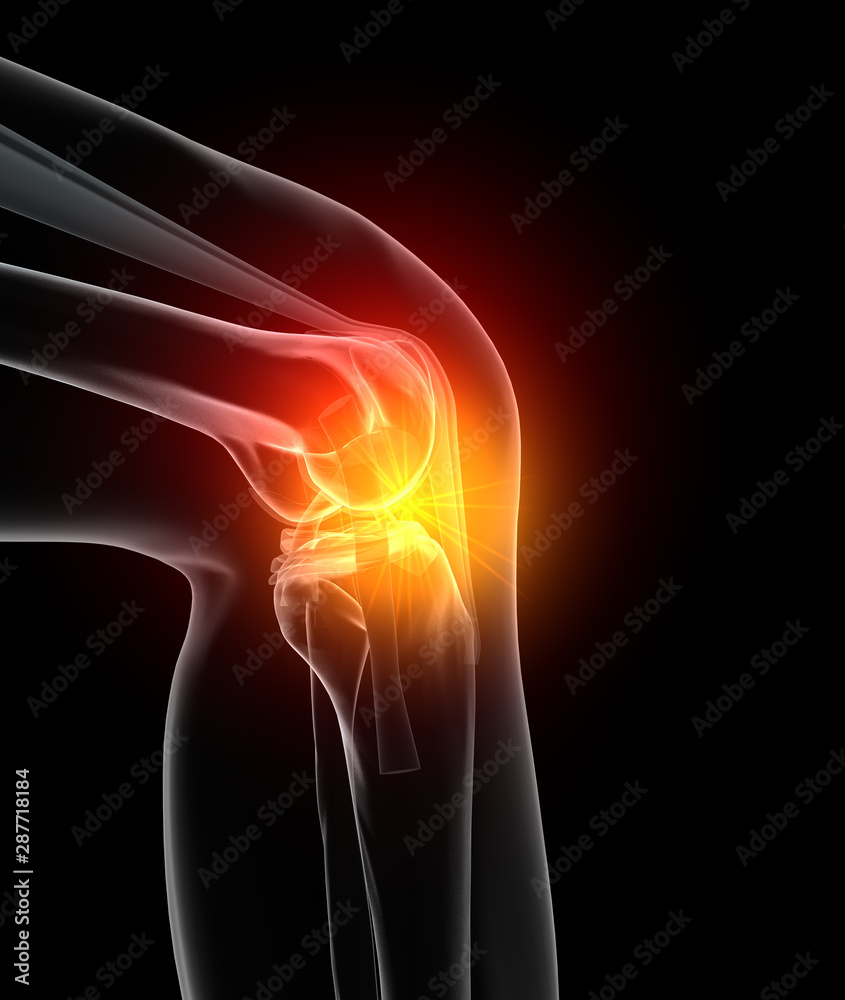 Painful osteoarthritic knee joint, medically 3D illustration