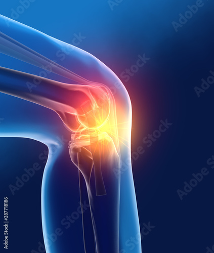 Painful osteoarthritic knee joint, medically 3D illustration photo