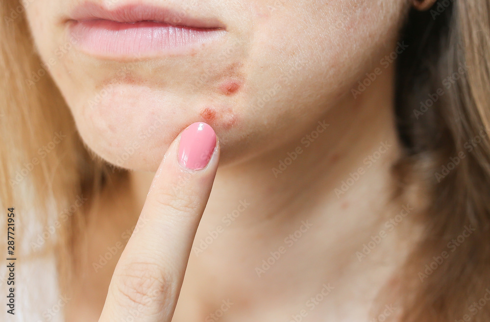 Woman's oily skin with acne problems. Scars and wounds on the face. Health care photo.