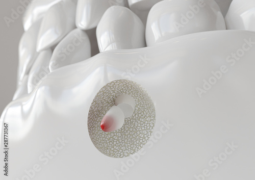 Root tip inflammation with apicectomy - 3D rendering
