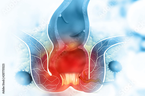 Haemorrhoids (piles) on scientific background. 3d illustration photo