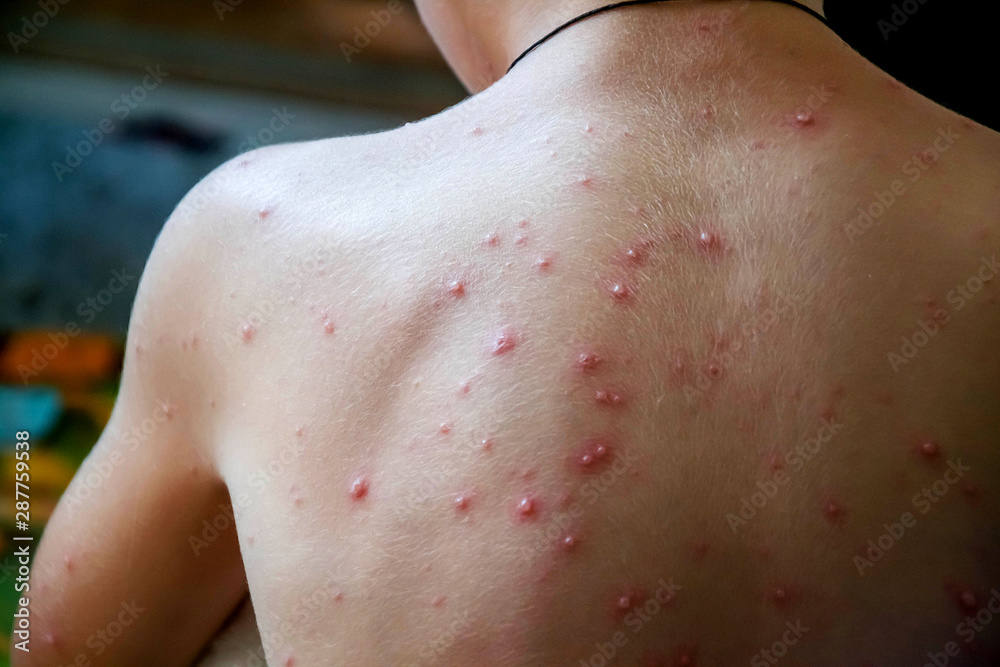 Varicella. A rash on the back of a boy. The child is sick with chicken pox. The benefits of vaccination. Red spots on back. Children's diseases.
