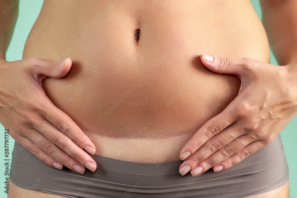 Close up of a caesarean section scar in a woman. Health and childbirth. Close up of a caesarean section scar in a woman. Health and childbirth.