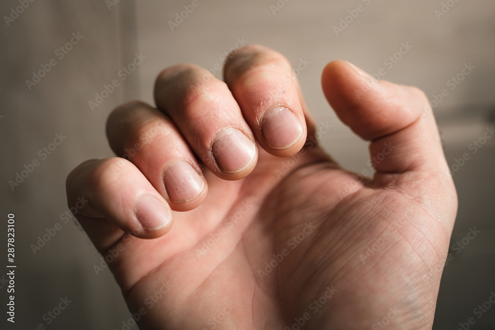 Dirty broken bitten nails without form and care - neglected condition of the hands, manicure is necessary Dirty broken bitten nails without form and care - neglected condition of the hands, manicure is necessary