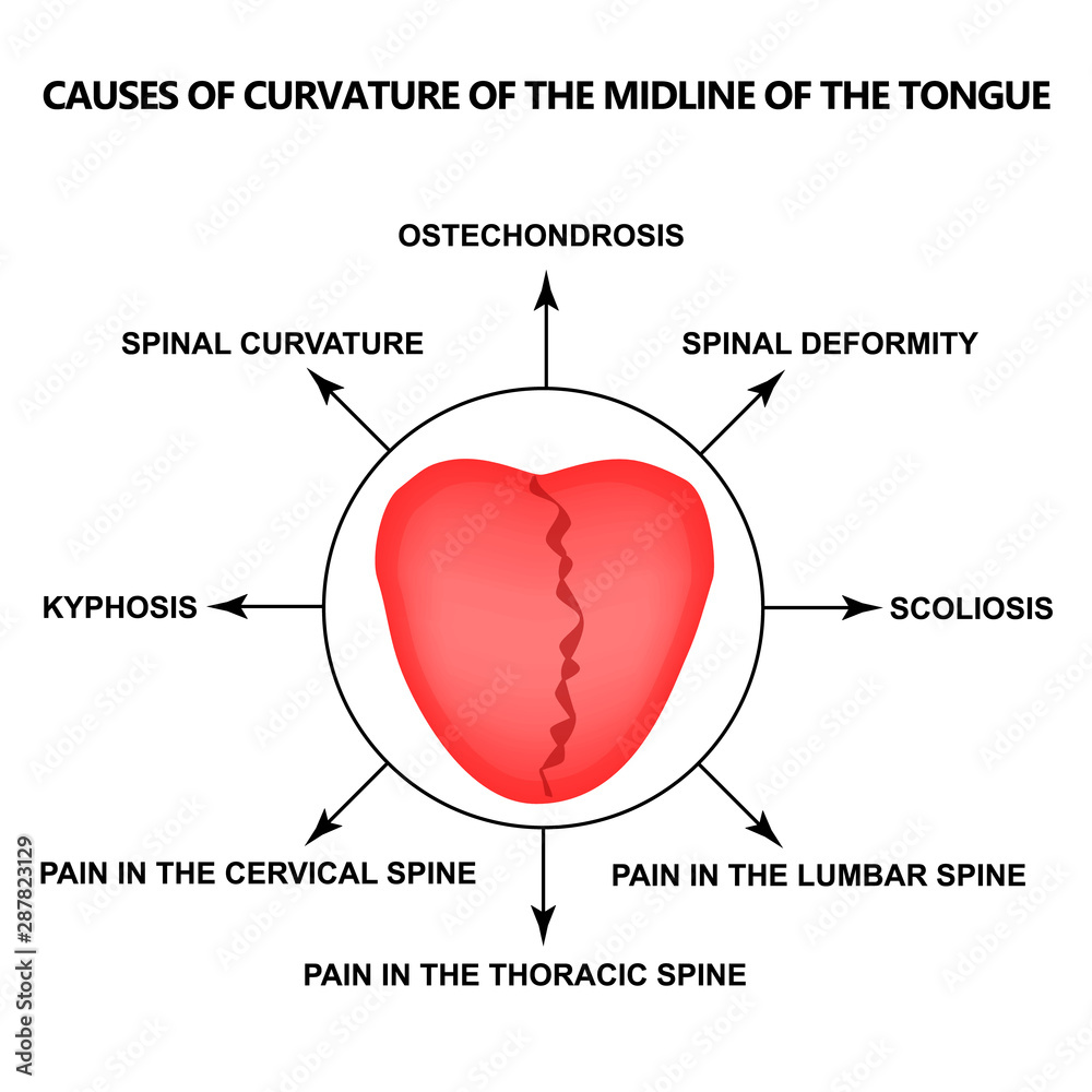 causes-of-curvature-of-the-midline-of-the-tongue-definition-of-a