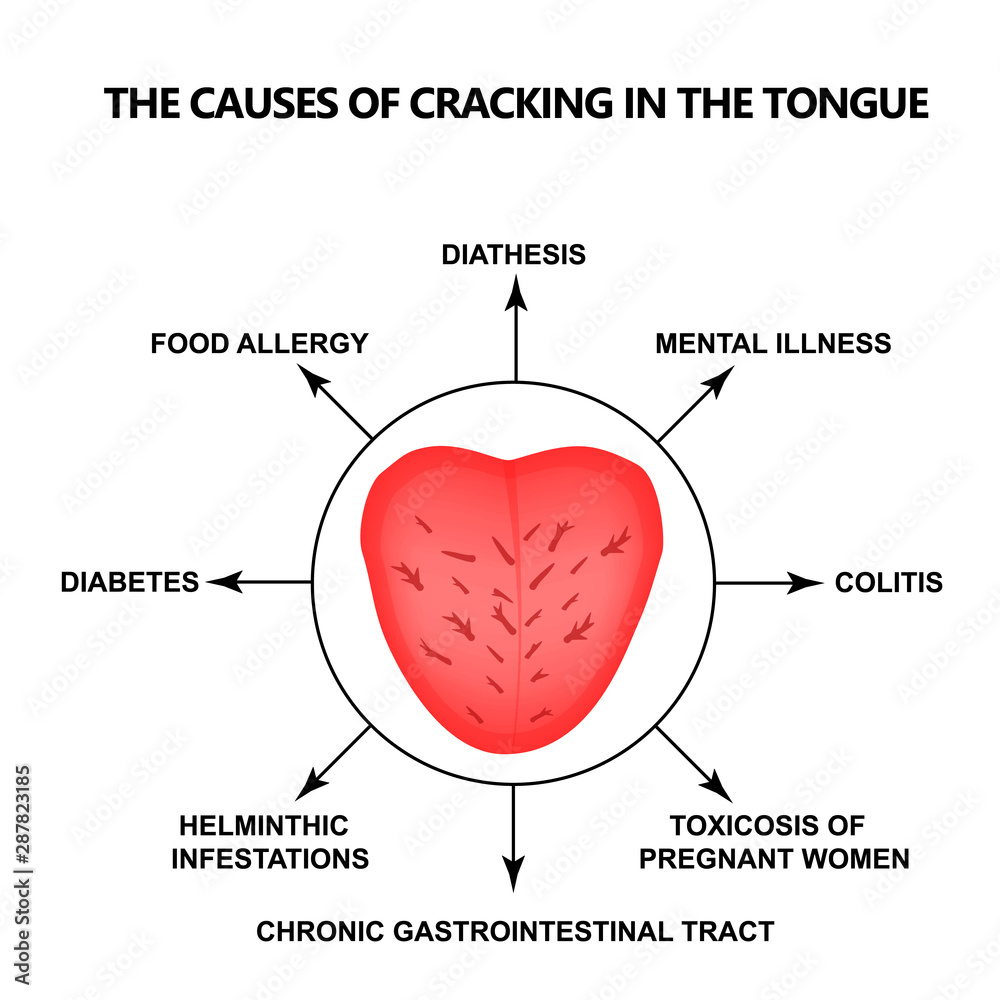 Vecteur Stock The causes of cracking in the tongue. Definition of a disease according to human