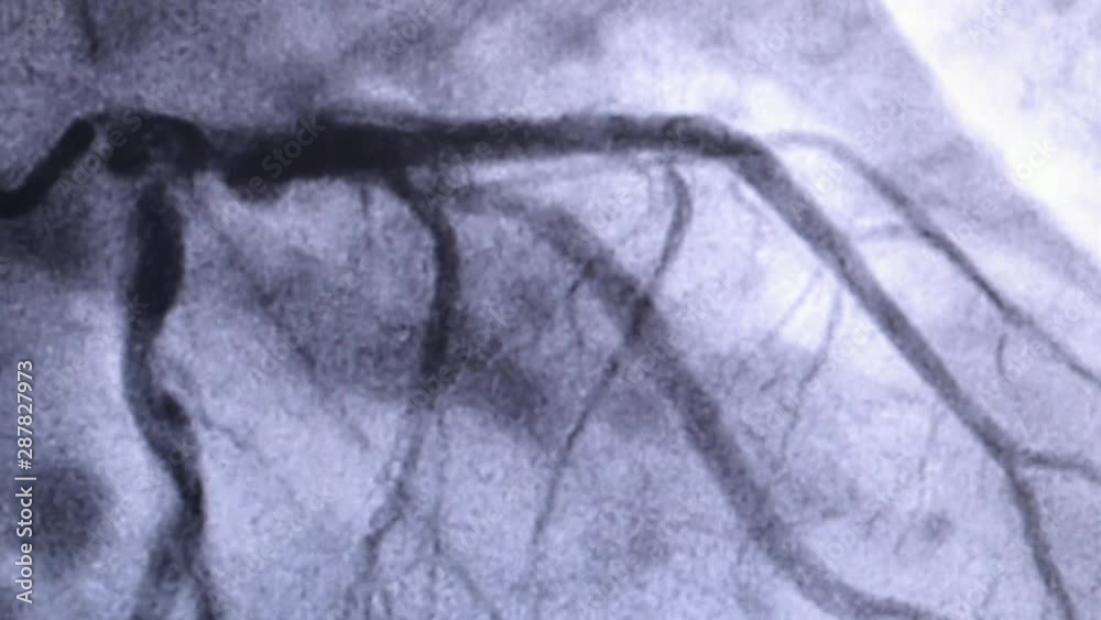 Vidéo Stock Catheterization. Cardiac ventriculography is a medical