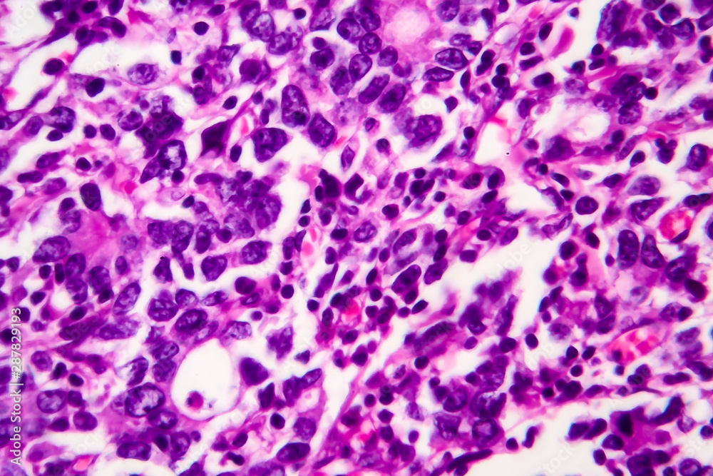 Gastric adenocarcinoma, light micrograph, photo under microscope. High magnification