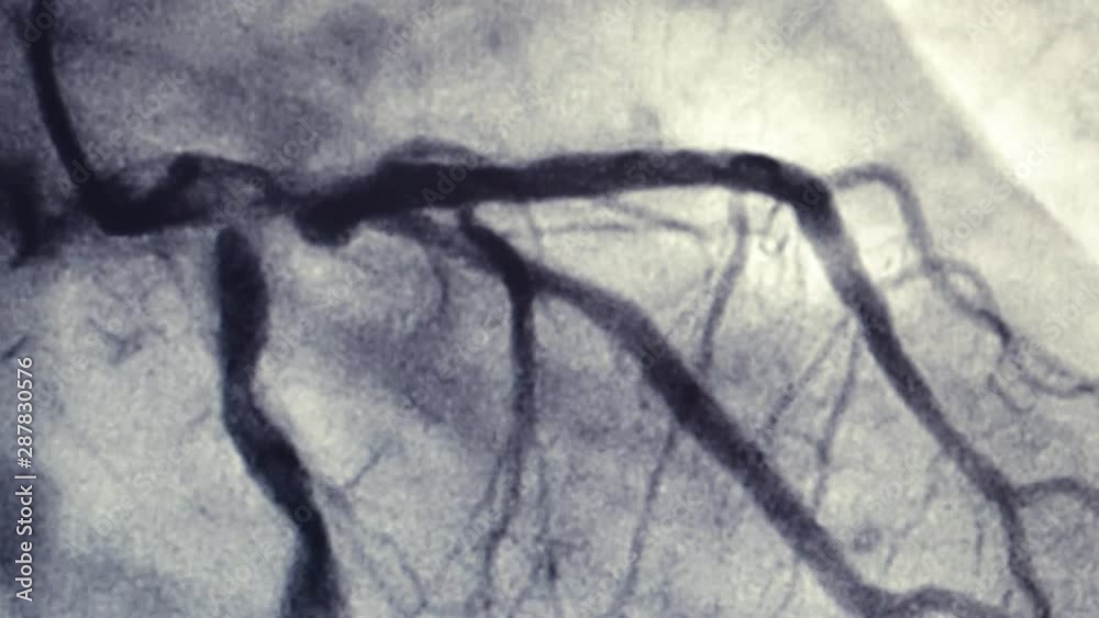 Catheterization. Cardiac ventriculography is a medical imaging test