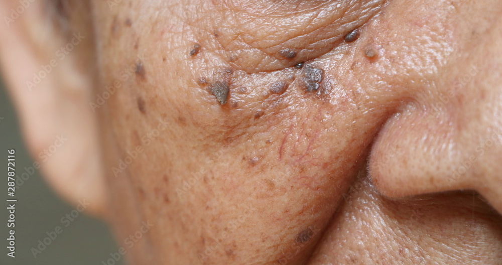 Ταπετσαρία Close up skin tags on wrinkles skin of Asian woman face
