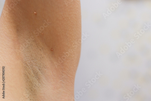 papillomas in the armpit on skin