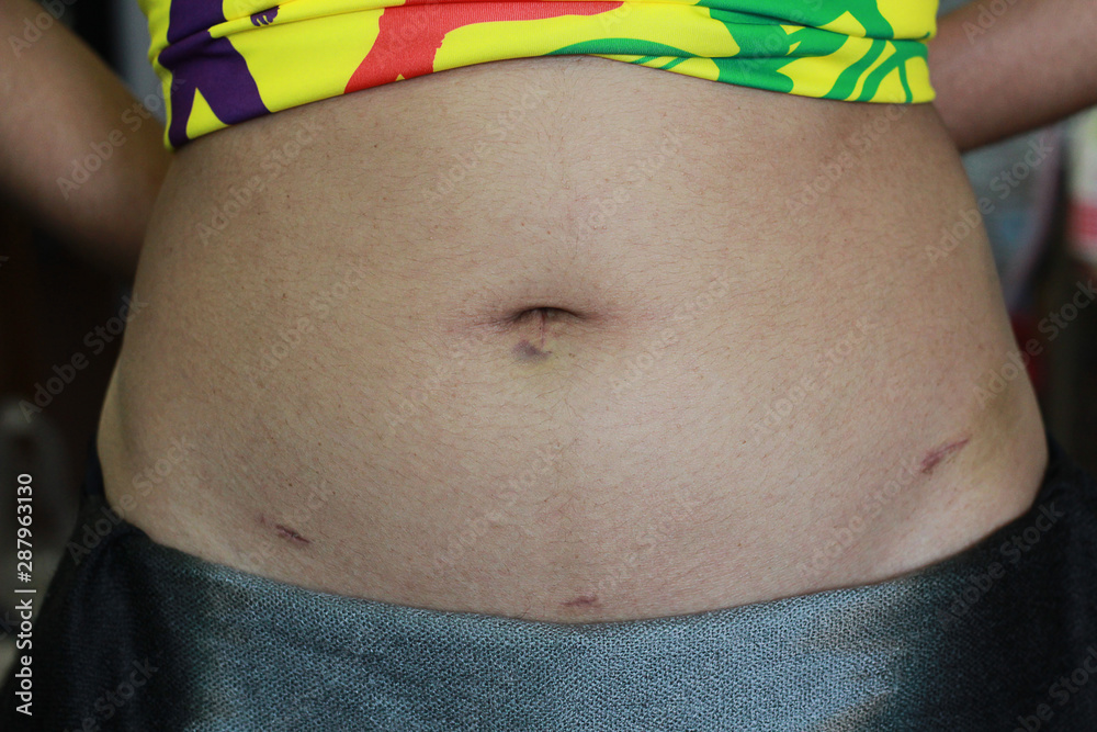 The scar of a young Asian women myoma case after myomectomy by