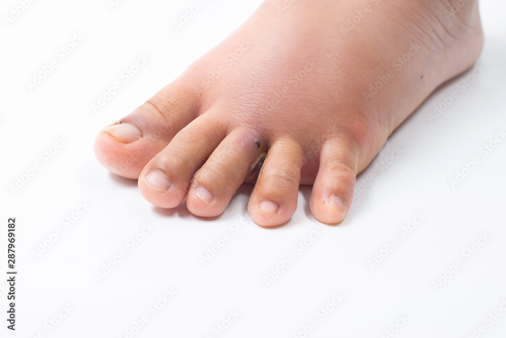 Nail bites ,Foot eczema On a white background