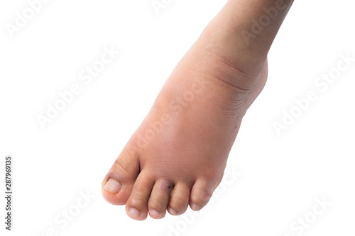 Nail bites ,Foot eczema On a white background, Disease that comes with floods © kanavit