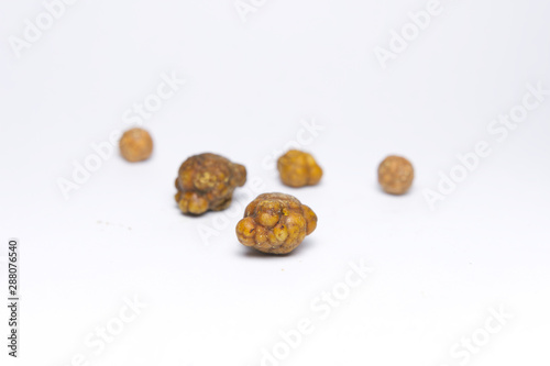 Gallstones,multiple cholesterol stone in gall bladder with cholecystitis .