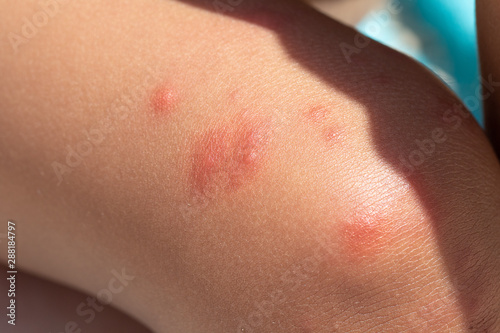 A close-up and detailed view on the knee of a little boy  red pus filled spots are seen around the upper leg  painful and red  symptomatic of chickenpox  varicella zoster virus .
