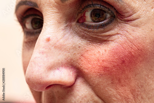 A close up view on the aging facial skin of a mature woman in her early fifties, with red flushing cheeks, open pores and superficial dilated blood vessels.