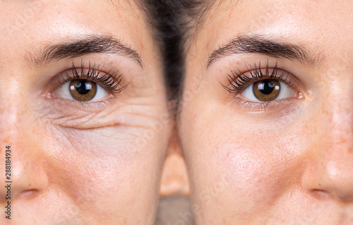 A young woman shows the before and after results of successful blepharoplasty surgery, corrective procedure to remove puffy and swollen bags beneath the eye. photo