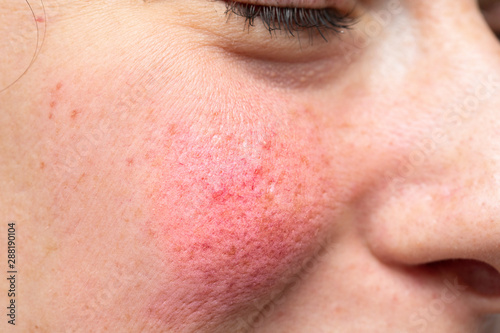 A macro view on the cheek of a young woman with severe erythema (visible blood vessels and capillaries), the most common symptom of rosacea.