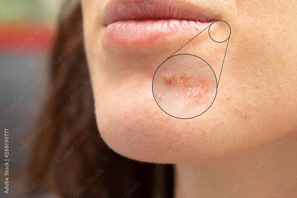 A magnified circle reveals a closer inspection of herpes simplex virus  (cold sores) on the mouth of a young caucasian woman, a common viral  infection causing painful pus filled spots. фотография Stock |