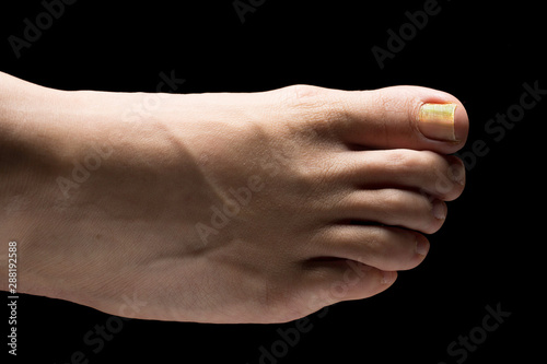 A close up and top view of a bare caucasian human foot, isolated against a black background, yellow and thickened toenails are seen in detail, symptomatic of tinea unguium, a fungal infection.