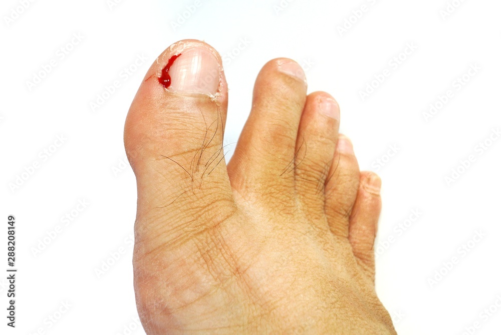 Foto de Excoriation (skinpicking) Disorder.Picking The Skin Around