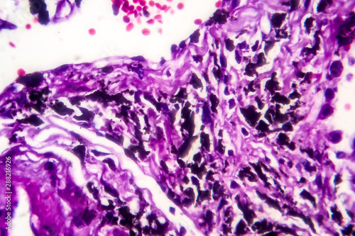 Histopathology of smoker's lung. Light micrograph showing accumulation of carbon particles in lung tissue