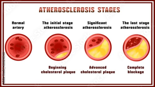 Atherosclerosis. Disturbance of lipid and protein metabolism, adjournment the cholesterol plaques in arteries. photo