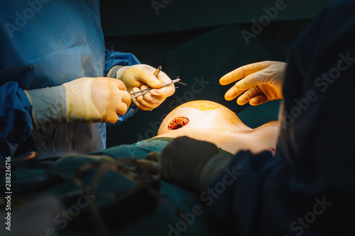 Plastic surgeon sewing up breast of female patient after inserting implants in operating room
