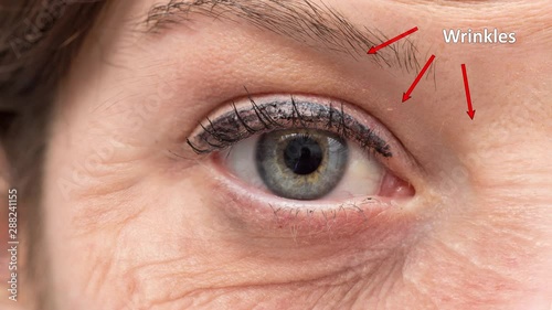 Different signs of age shown in the same eye